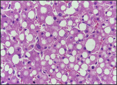 note fat vacuoles within hepatocytes