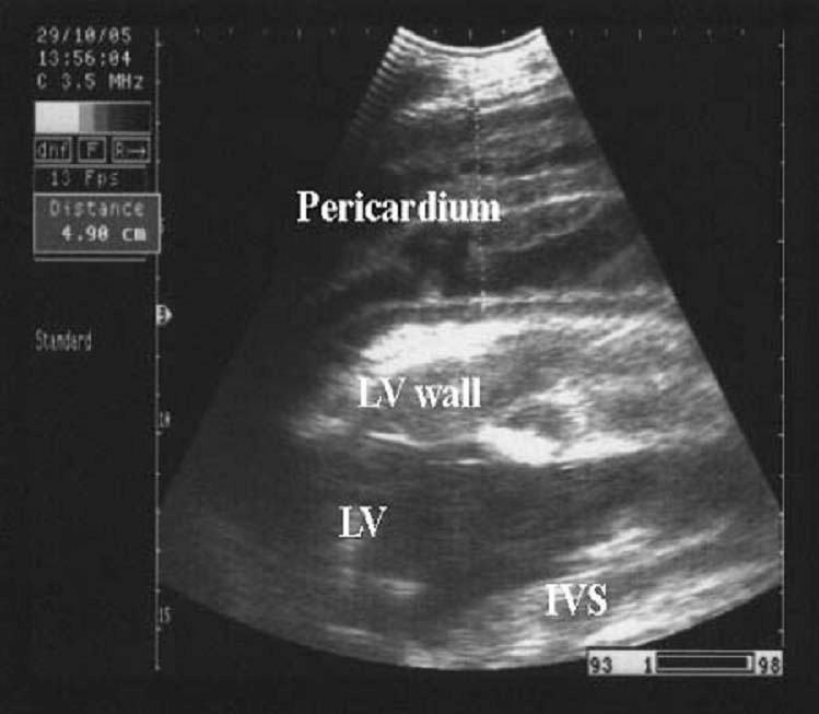 Ultrasonogram in a cow affected with fibrinous pericarditis. On the outside of the pericardium, fibrinous layers are floating in the fluid. Image was taken from the fifth intercostal space on the left side of the thorax. IVS = interventricular septum; LV = left ventricle; LV wall = left ventricular wall.